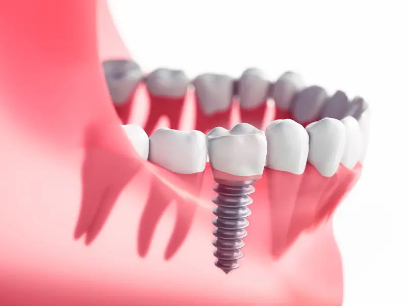Dental Implants in Missisauga