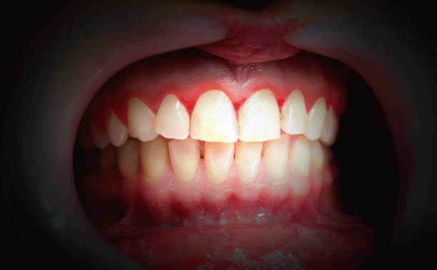 DrDalmao-Mouth with bleeding gums on a dark background. Close up.