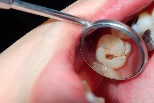 DrDalmao-A dental tooth decay cavity found during routine dental examination check up using a dental mirror reflection