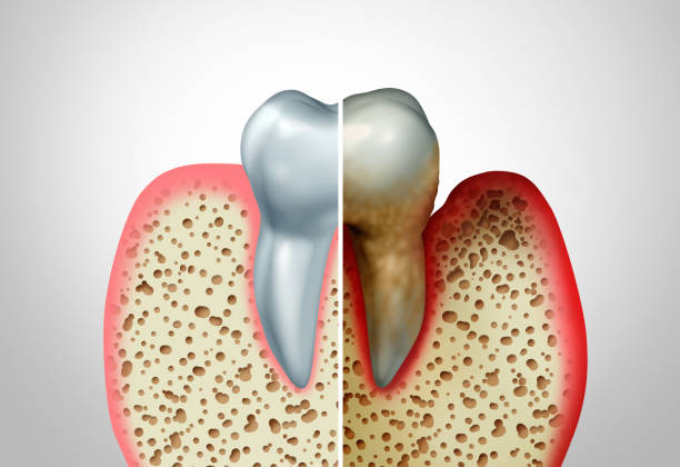 DrDalmao-Gum disease comparison with a healthy tooth and an unhealthy one with periodontitis and poor oral hygiene health problem as a bacteria infection diagram concept with inflammation as a 3D illustration.