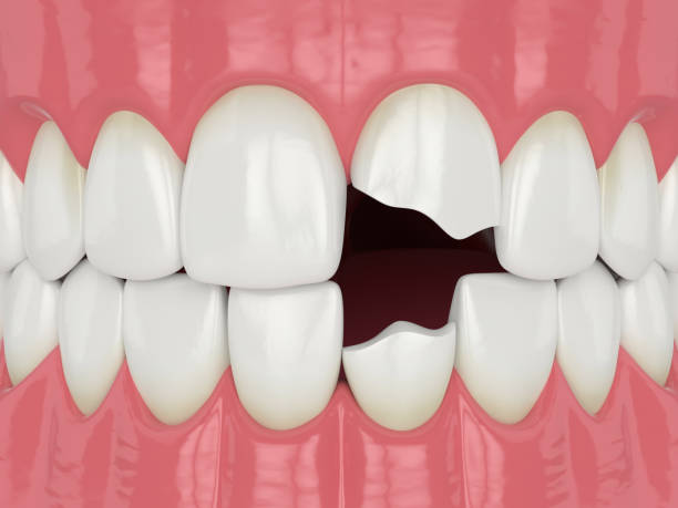 DrDalmao-3d render of jaw with broken two incisors teeth