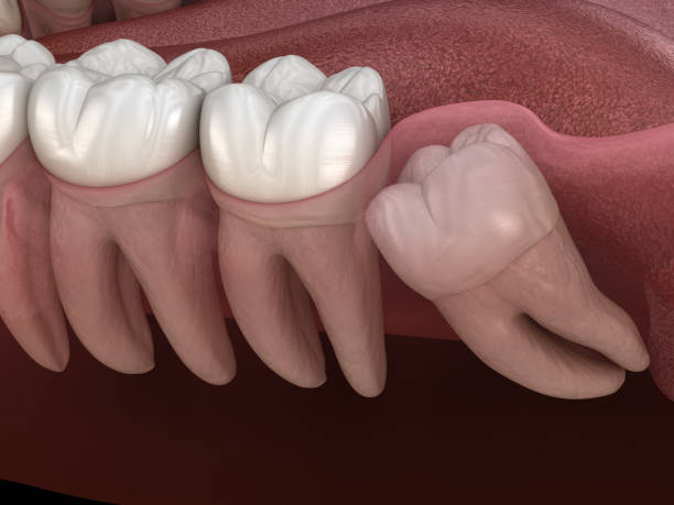 DrDalmao-Wisdom tooth with impaction at molar tooth. Medically accurate tooth 3D illustration