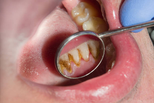 DrDalmao-Close-up of macro dental calculus and dental plaque. Oral hygiene in dentistry