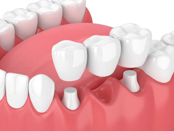 DrDalmao-3d render of jaw with dental bridge  over white background
