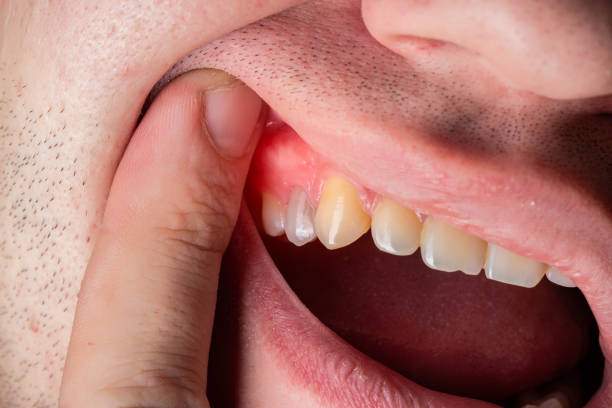 DrDalmao-Red and swollen gums in a man. Gum disease gingivitis, gumboil and inflammation