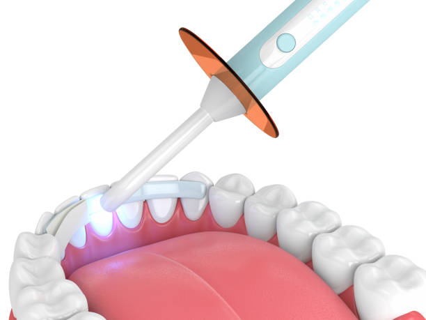 DrDalmao-3d render of jaw with dental polymerization lamp and dental fiber over white background