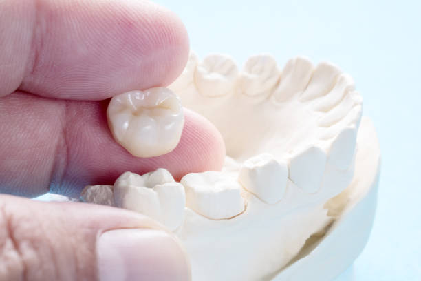 DrDalmao-Closeup / Prosthodontics or Prosthetic / Crown and bridge equipment and model express fix restoration.