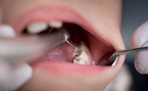 DrDalmao-Open mouth during drilling treatment at the dentist in dental clinic. Close-up. Dentistry