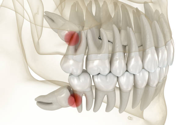 DrDalmao-Mesial impaction of Wisdom teeth. Medically accurate tooth 3D illustration