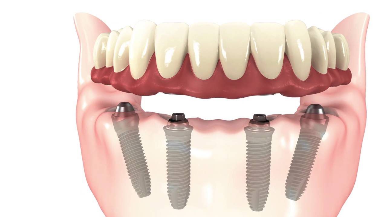 drdalmao-All-on-4 and All-on-6 Implants