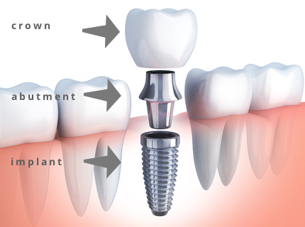 DrDalmao-Dental Implants