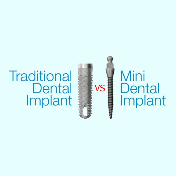 types of dental implants: traditional vs. mini