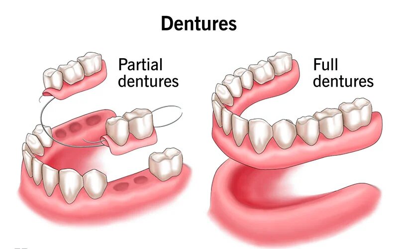 The difference between partial dentures and full dentures