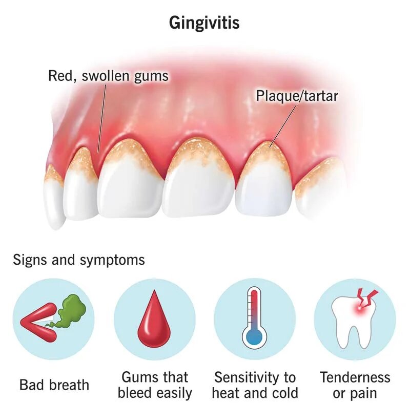  Signs of periodontal disease