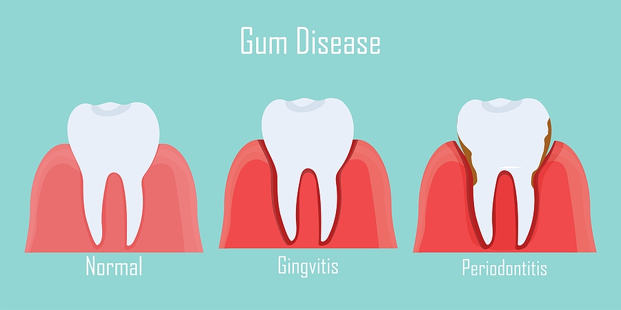 Infographic showing the stages of gum disease 