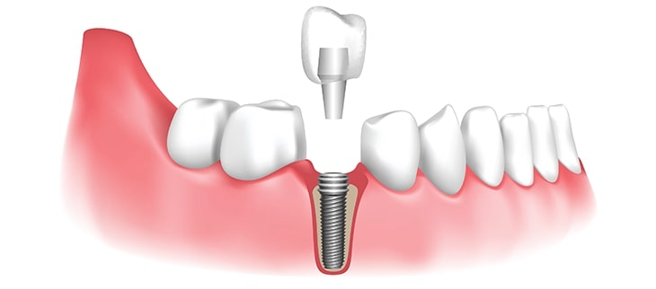 Dental implants - showing a titanium post implanted into the jaw bone and how the crown will be screwed on to attach