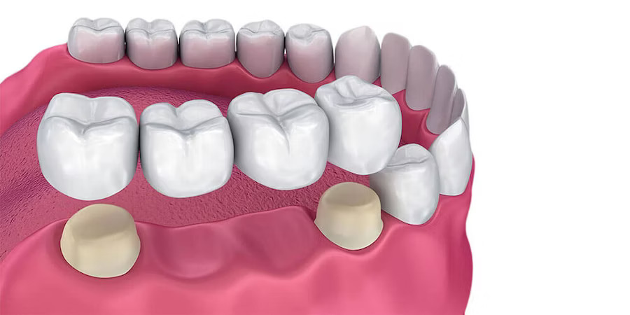 Placement of dental bridge 