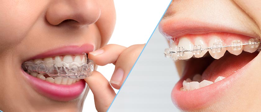 Treatment Options for an uneven bite: clear aligners, braces