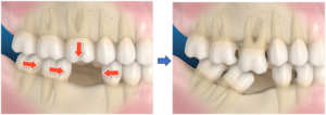 A missing tooth can cause surrounding teeth to shift in its place