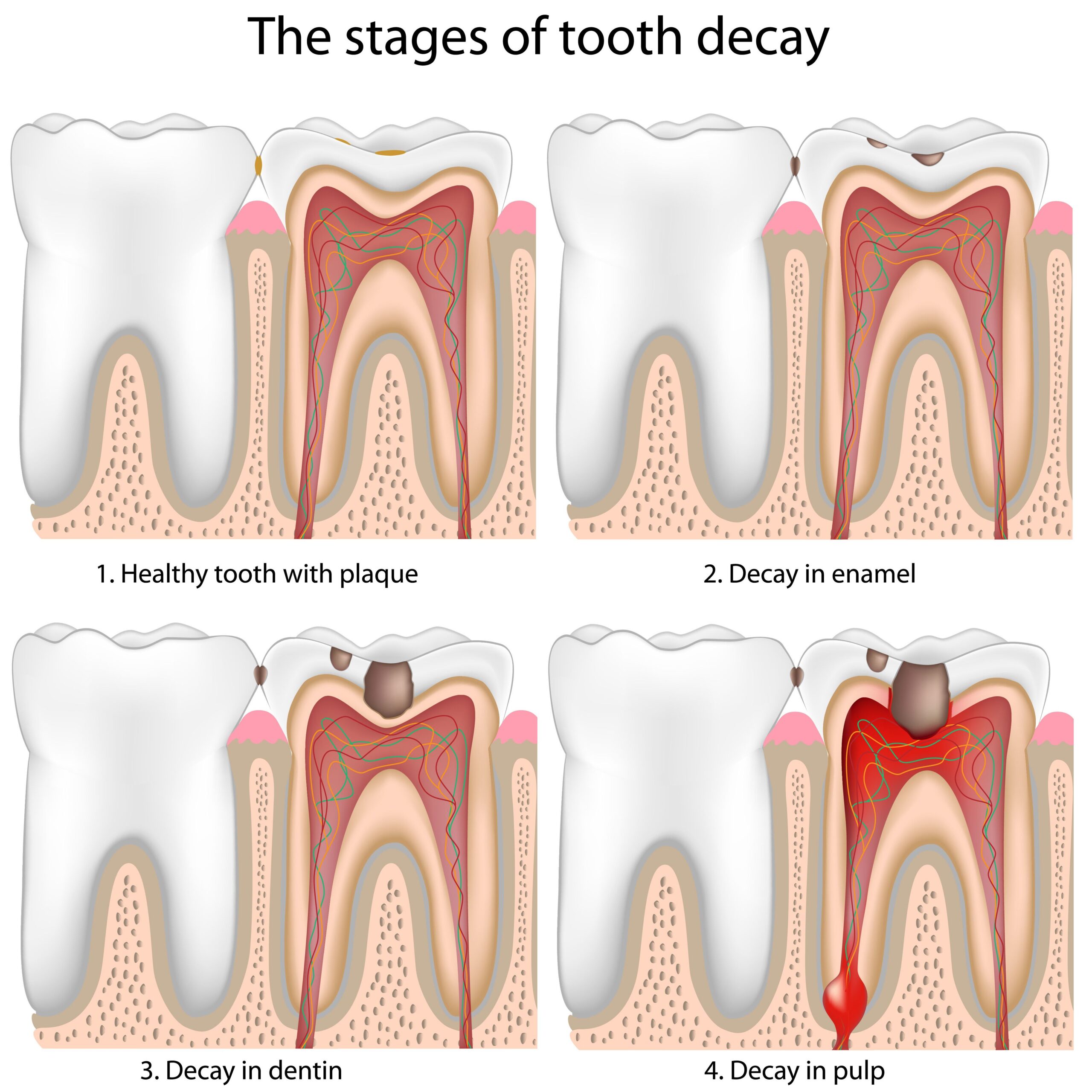 The stage of tooth decay
