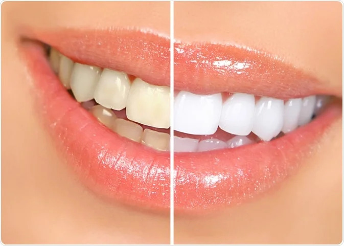 The Dos and Don’ts of Teeth Whitening Treatment