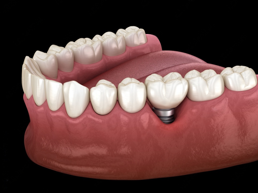 Gum Recession can lead to dental implant failure