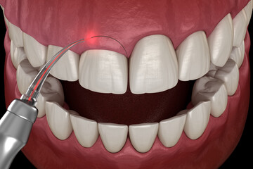 laser used to remove excess gum tissue