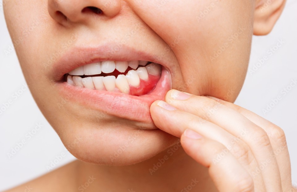 Showing of inflammed gums from gum disease