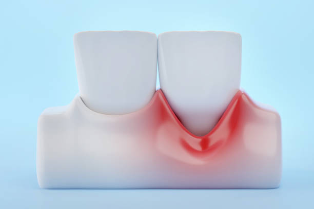 Gingival Recession and front teeth on blue background 3D rendering