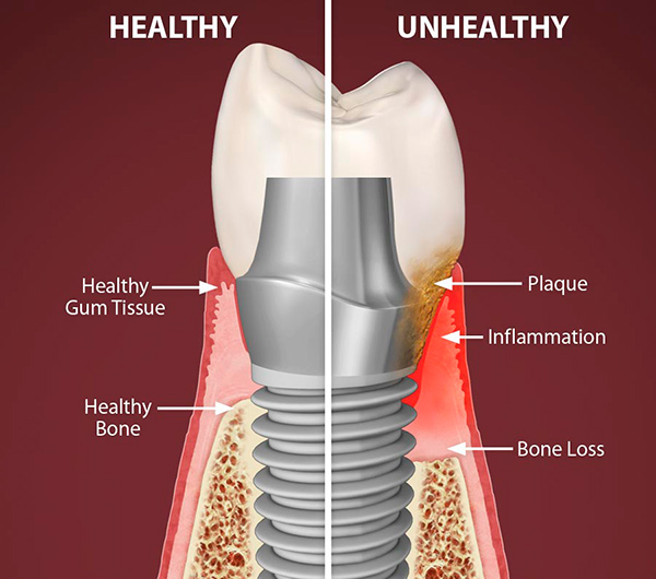 Understanding Dental Implant Failure: Causes and Prevention