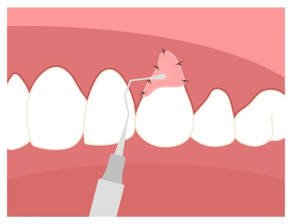 recession-gummy-smile-dentistry-root-600nw-2245400869