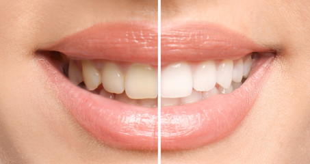 Fix discolouration with teeth whitening treatment