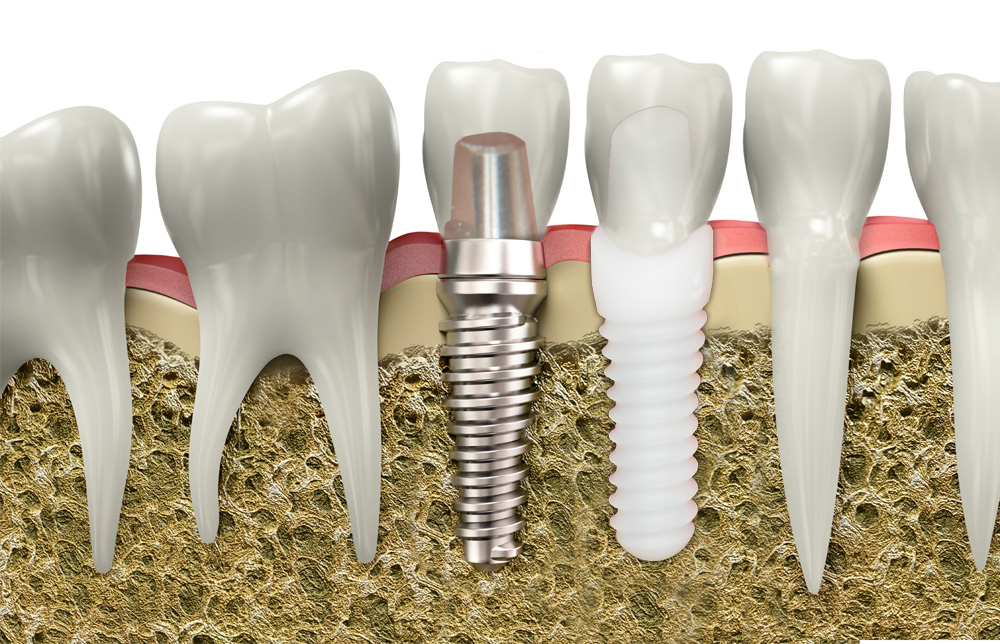 Ceramic Vs. Titanium Dental Implants: A Guide - Dental Implant Center