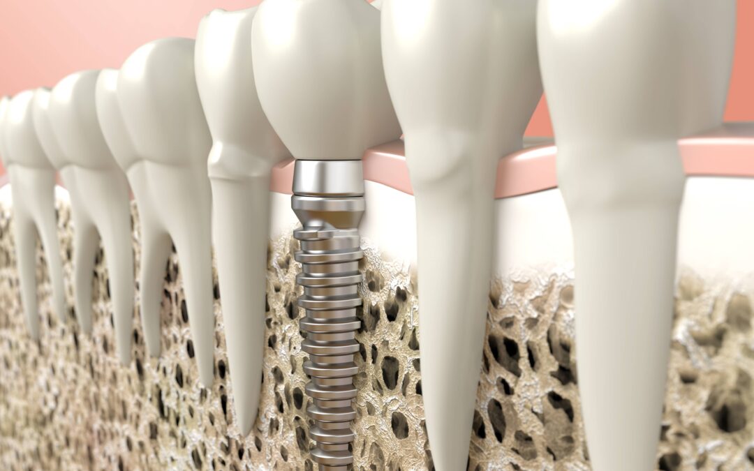structure-of-dental-implant-1080x675